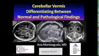 AIUM Webinar: Cerebellar Vermis