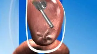 NJ ROSE Procedure - Endoscopic Gastric Bypass Revision