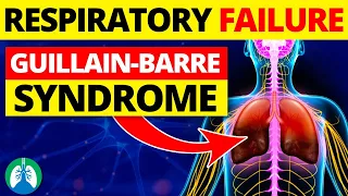 Respiratory Failure Caused by Guillain-Barre Syndrome