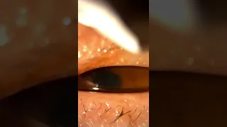 Unblocking oil glands in your eyelid with eyelid massage