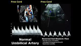 Umbilical Artery Doppler Ultrasound Normal Vs Abnormal Image Appearances | Spectral Doppler USG