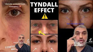 BEWARE of Under Eye Filler: It only works for THESE people!