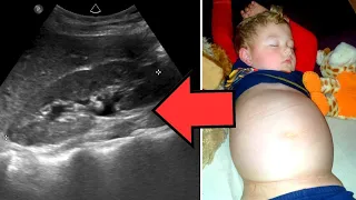 Doctors Stunned by What They Found Inside 3 Year Old’s Growing Belly—It's Not a Baby!