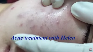 Make Your Acne Treatment - Helen Beauty #008  | Acne 2022