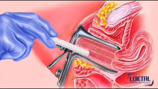 Fraxx - Tratamento Vaginal com Radiofrequência Fracionada Microablativa