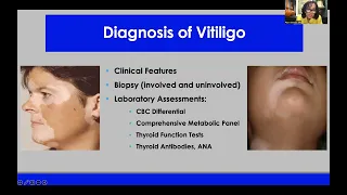 Advances in the Pathogenesis and Treatment of Vitiligo - Pearl E. Grimes MD