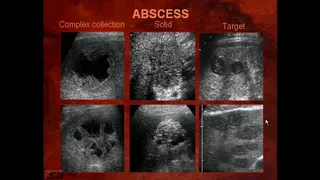 Sonography of Liver Masses