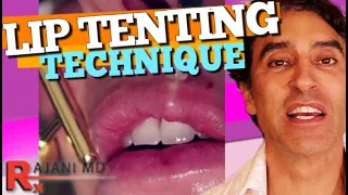 LIP FILLER RUSSIAN TENTING TECHNIQUE Demonstrated - Lip Filler Before and After