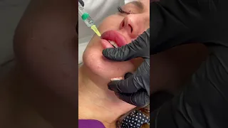 Растворение филлера в губах , гиалуронидазой
