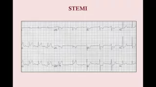 Acute Coronary Syndromes - CRASH! Medical Review Series