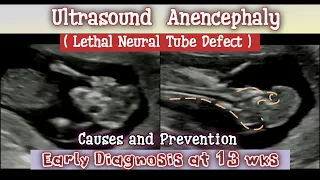 Fetal Lethal Congenital Anomaly - Anencephaly | 13 Weeks  Pregnancy