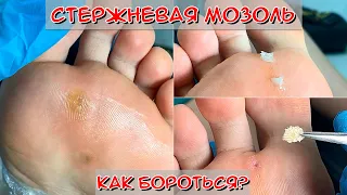 Core callus on the foot 🦶 / Why do calluses appear?