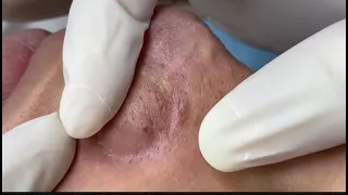 2 BIG BLACKHEAD , WHITEHEAD REMOVAL | NOSE | RELAX EVERYDAY WITH SATSPA | SATISFYING | ACNE |PIMPLE