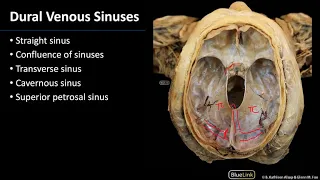 Cranial Cavity and Brain - Dural Venous Sinuses