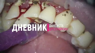 удаление зубного камня и зубного налета ультразвуком #стоматология #пломба #имплант #кариес #