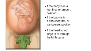 How Cesarean Delivery Done Animation - What Causes C Section? How Anesthesia Given Video