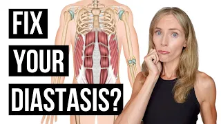 Can Diastasis Recti Be Fixed? (DR In Men & Postpartum Women)