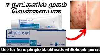 Adapalene gel uses in tamil | best oilment to reduce pimple and acne | skin whitening cream