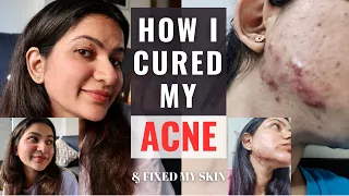 How I Cured My Severe Adult Acne & Fixed My Skin Naturally + Current Skincare Routine |Shreyashi Jha