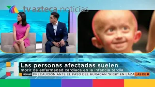 "El curioso caso de Benjamin Button" tiene explicación científica. ¿Qué es la progeria?