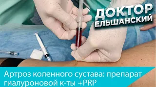 Лечение артроза коленного сустава - препарат гиалуроновой кислоты + PRP