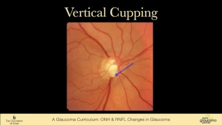 9 EXAMINATION Optic Nerve Head and Nerve Fiber Layer Changes in Glaucoma