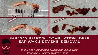EAR WAX REMOVAL COMPILATION - DEEP EAR WAX & DRY SKIN REMOVAL - EP 281