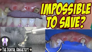 Patient Thought Her Bridge Can No Longer Be Saved. How To Save a Patient's Teeth and Bridge #C15