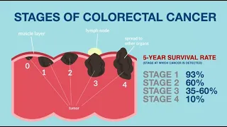 Beat Colon Cancer: Advocacy Video on Colorectal Cancer Screening