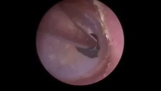 769 - Stone Extracted From Deep Ear Canal