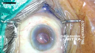 WHEN ADRENALINE DOESNT WORKS - PHACO(SEMI-DILATED TO UNDILATED)  (unedited video)- DR ASHISH MITRA