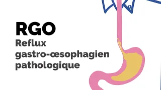 Reflux gastro-œsophagien (RGO) pathologique | Société gastro-intestinale
