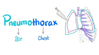 Pneumothorax - Spontaneous vs Tension Pneumothorax - Lung Physiology - Pulmonary Medicine