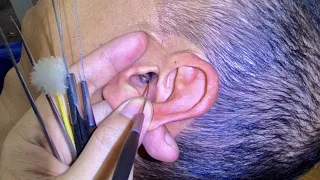 耳掃除 귀 청소 Ear Cleaning #343