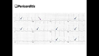 ECG course: STEMI or Pericarditis? Dr. Sherif Altoukhy