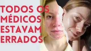 Como eu Curei Minha Acne | Sem Roacutan e sem Anticoncepcional