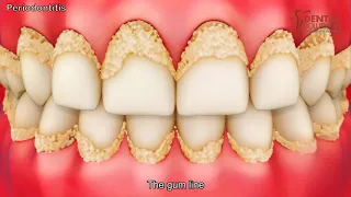 Periodontitis – Causes, Symptoms, Risk Factors 3d dental animation