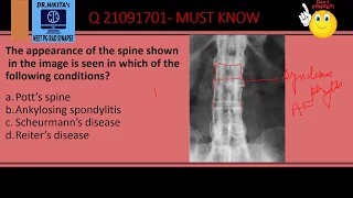 BAMBOO SPINE- ANKYLOSING SPONDYLITIS