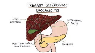 Primary Sclerosing Cholangitis: Visual Explanation for Students