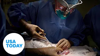 Surgeon transplants a pig's kidney into a brain-dead human in groundbreaking surgery | USA TODAY