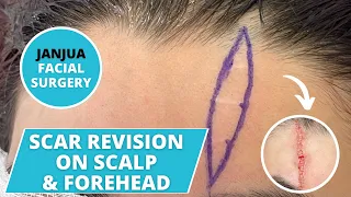 SCAR REVISION ON SCALP AND FOREHEAD - DR. TANVEER JANJUA - NEW JERSEY