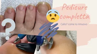 👣Pedicure con fresa/ 🦶Unghie trascurate/ Come rimuovere i duroni e i calli./Kombi pedicure