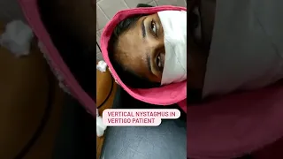 vertical nystagmus (involuntary up and down movements of eyeball) in a patient having vertigo