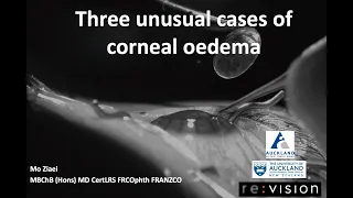 Three unusual cases of corneal oedema (presentation)