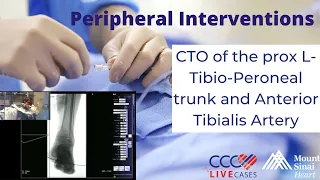 CTO of the prox L-Tibio-Peroneal trunk and Anterior Tibialis Artery - August 22, 2012 Live Case