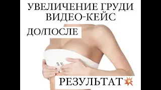 Увеличение груди До/После Маммопластика Результат Анеликов Андрей Пластический хирург