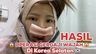 PERJUANGAN OPERASI GERG4JI WAJAH SENDIRI DI KOREA 🇰🇷