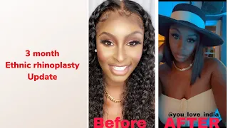 ethnic rhinoplasty  3 month update