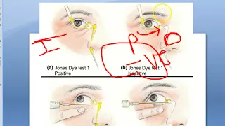 Ophthalmology Jones Dye Test Lacrimal Apparatus Watering eye Partial obstruction pump failure