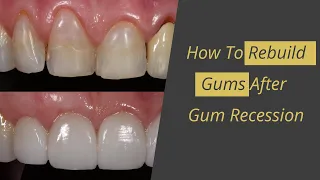 Gum Recession Cure - How to Rebuild Gums